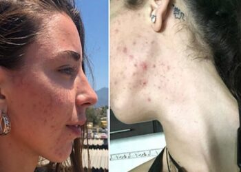 27χρονη πρώην βίγκαν εξομολογείται: «Ήμουν συνέχεια άρρωστη, μου έπεσαν τα μαλλιά. Έφαγα κρέας και σώθηκε η ζωή μου» (video)