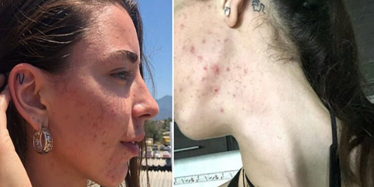 27χρονη πρώην βίγκαν εξομολογείται: «Ήμουν συνέχεια άρρωστη, μου έπεσαν τα μαλλιά. Έφαγα κρέας και σώθηκε η ζωή μου» (video)