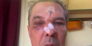 Ξυλοδαρμός σε ιατρείο – Του μαύρισε το μάτι και τον έστειλε στο νοσοκομείο για ασήμαντη αφορμή (video)