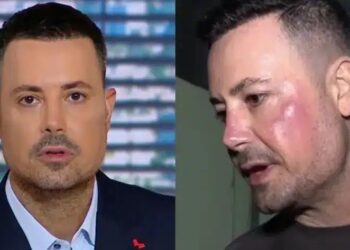 Πέτρος Κουσουλός: Τι είναι η γυροειδής αλωπεκία που τον ταλαιπωρεί – Η μάχη με το αυτοάνοσο και η νέα διάγνωση