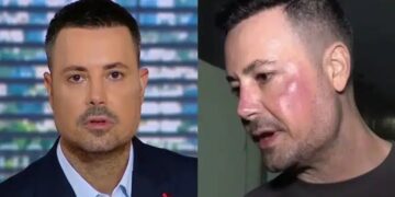 Πέτρος Κουσουλός: Τι είναι η γυροειδής αλωπεκία που τον ταλαιπωρεί – Η μάχη με το αυτοάνοσο και η νέα διάγνωση