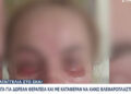 Εφιάλτης σε γνωστό Ινστιτούτο Αισθητικής: «Με έκαψε τόσο βαθιά που μέχρι και σήμερα υποφέρω» – Ανειδίκευτος ο γιατρός που έκανε βλεφαροπλαστική (video)