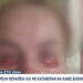 Εφιάλτης σε γνωστό Ινστιτούτο Αισθητικής: «Με έκαψε τόσο βαθιά που μέχρι και σήμερα υποφέρω» – Ανειδίκευτος ο γιατρός που έκανε βλεφαροπλαστική (video)